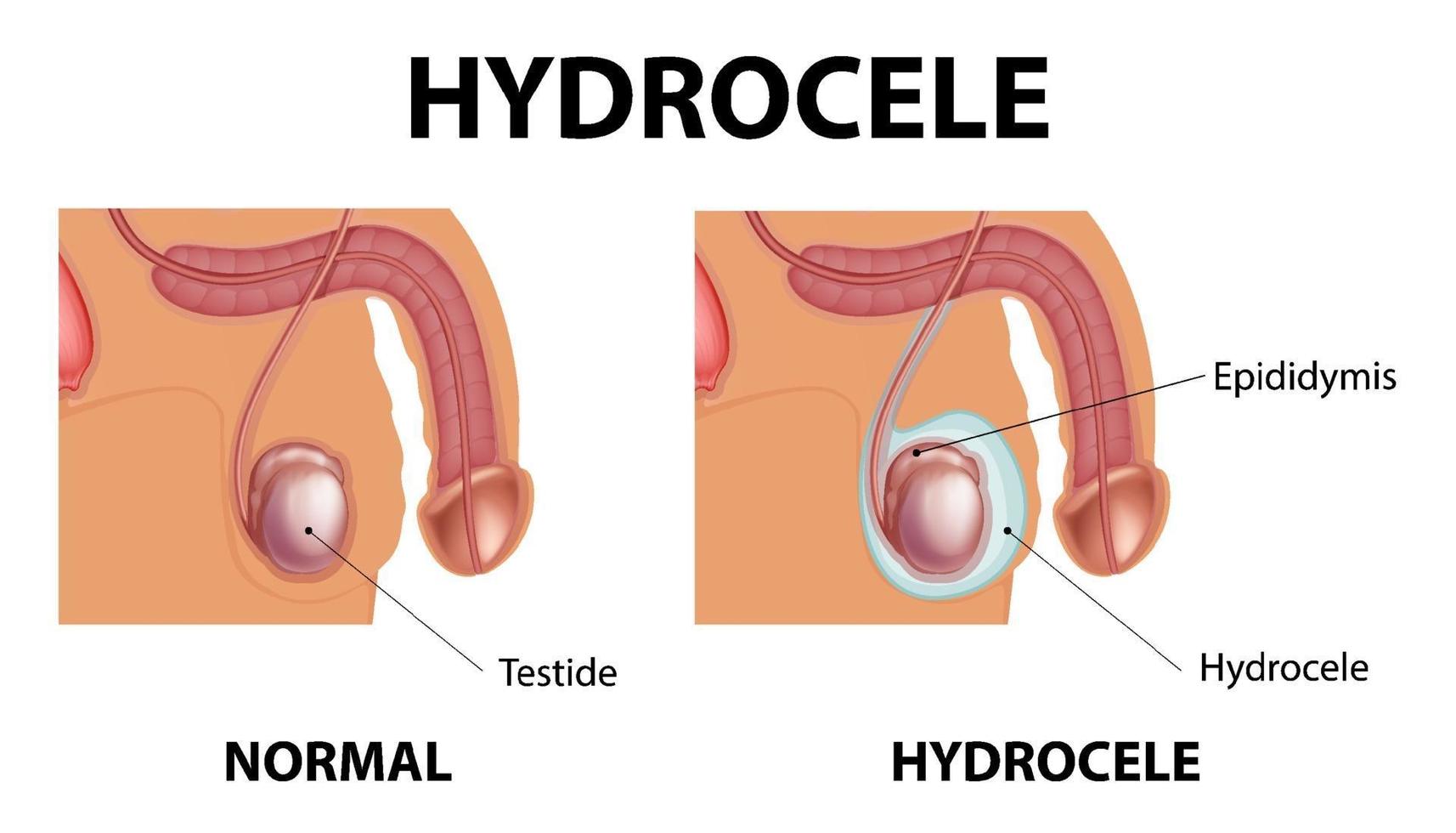 Human hydrocele symptoms diagram vector