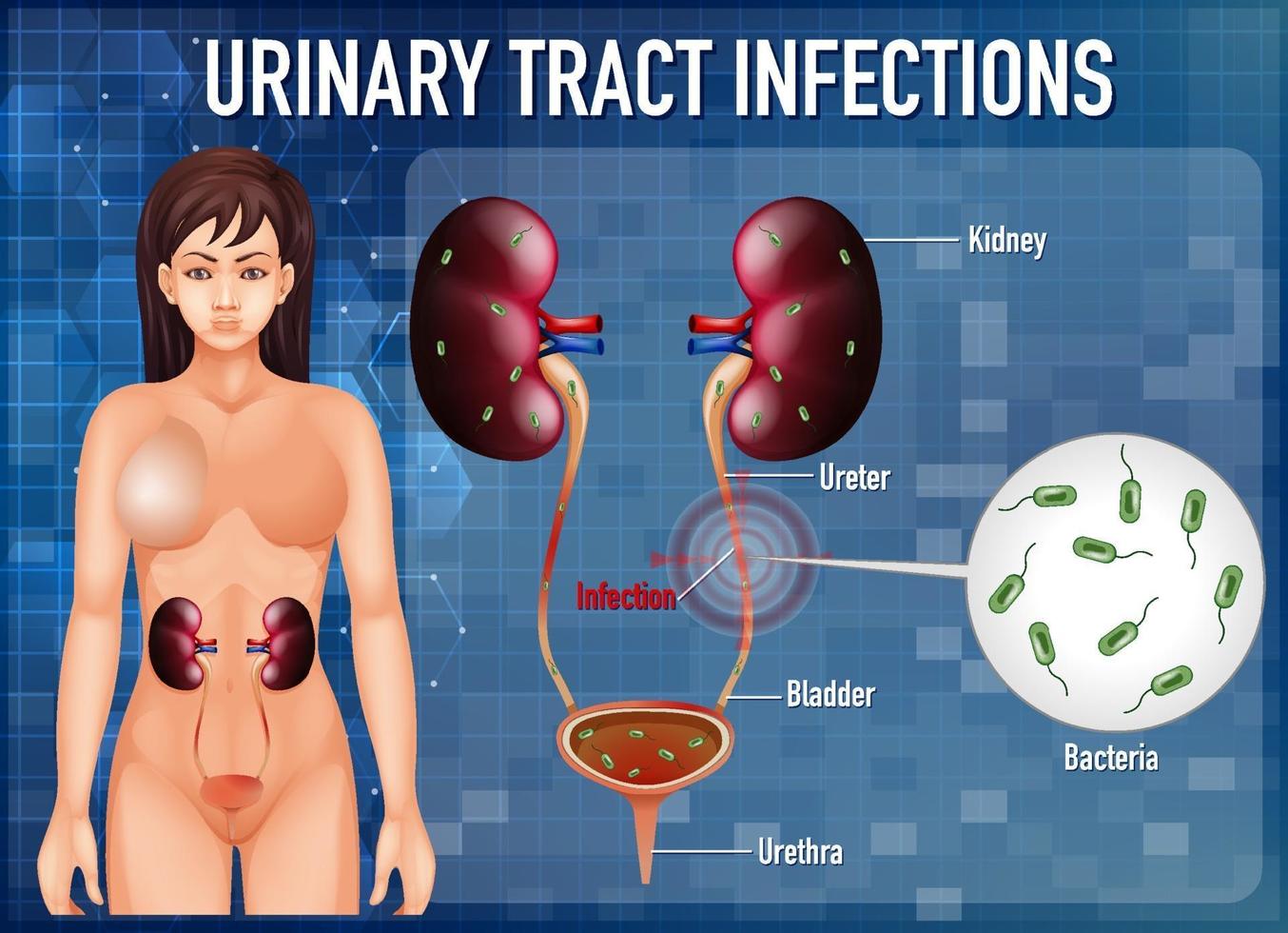 cartel informativo sobre infecciones del tracto urinario vector