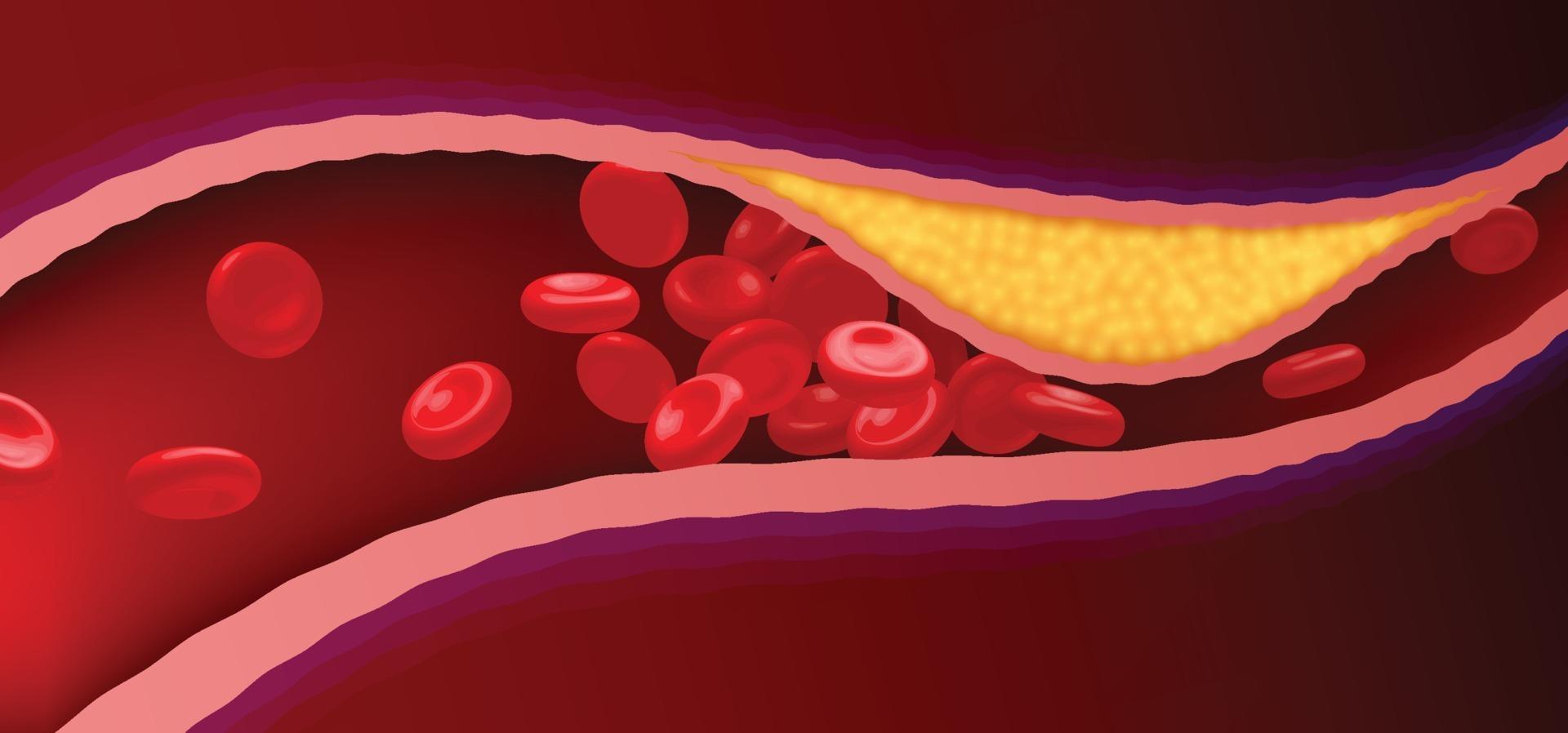 Arteries with clogged fat that causes blood clots. vector