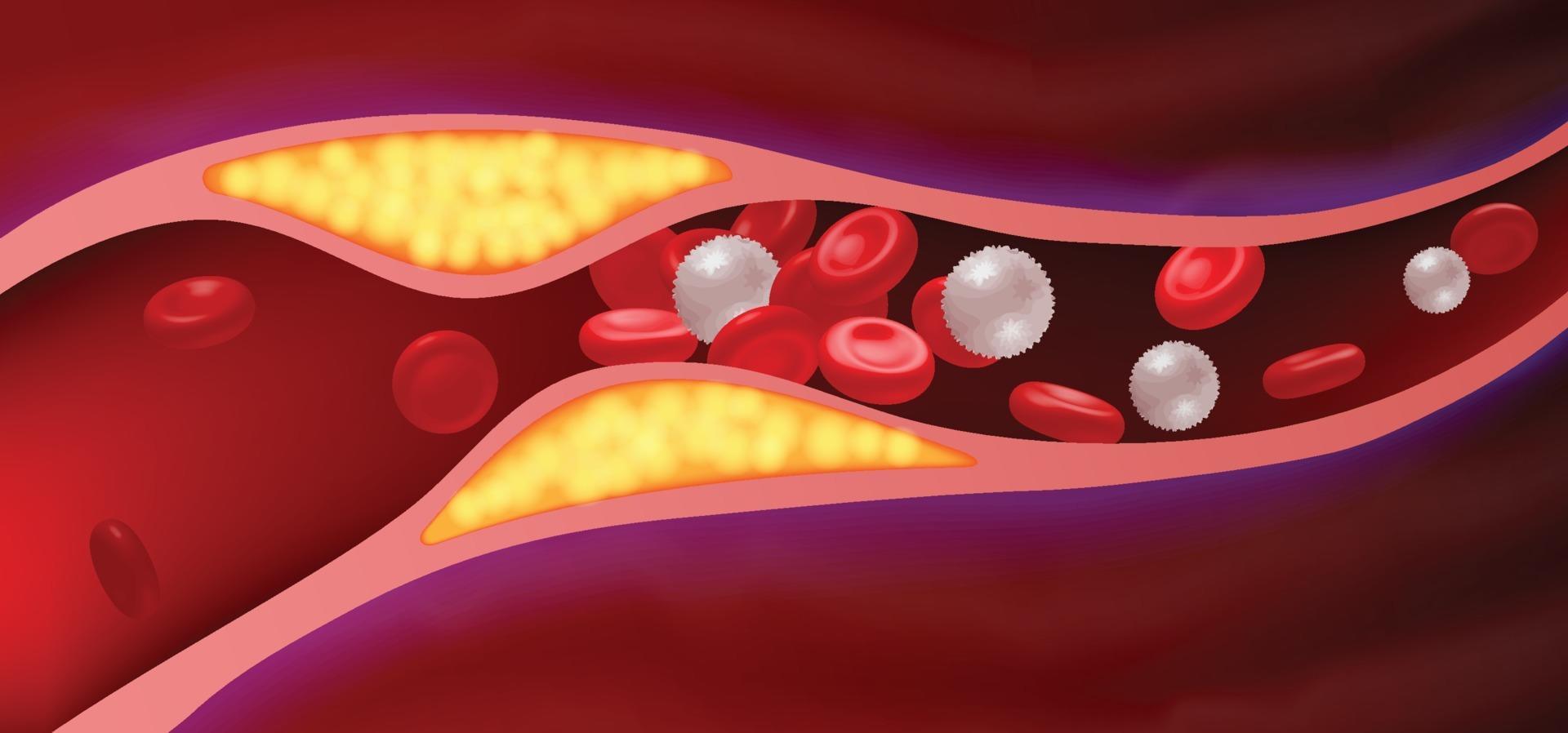 Arteries with clogged fat that causes blood clots. 1937778 Vector Art