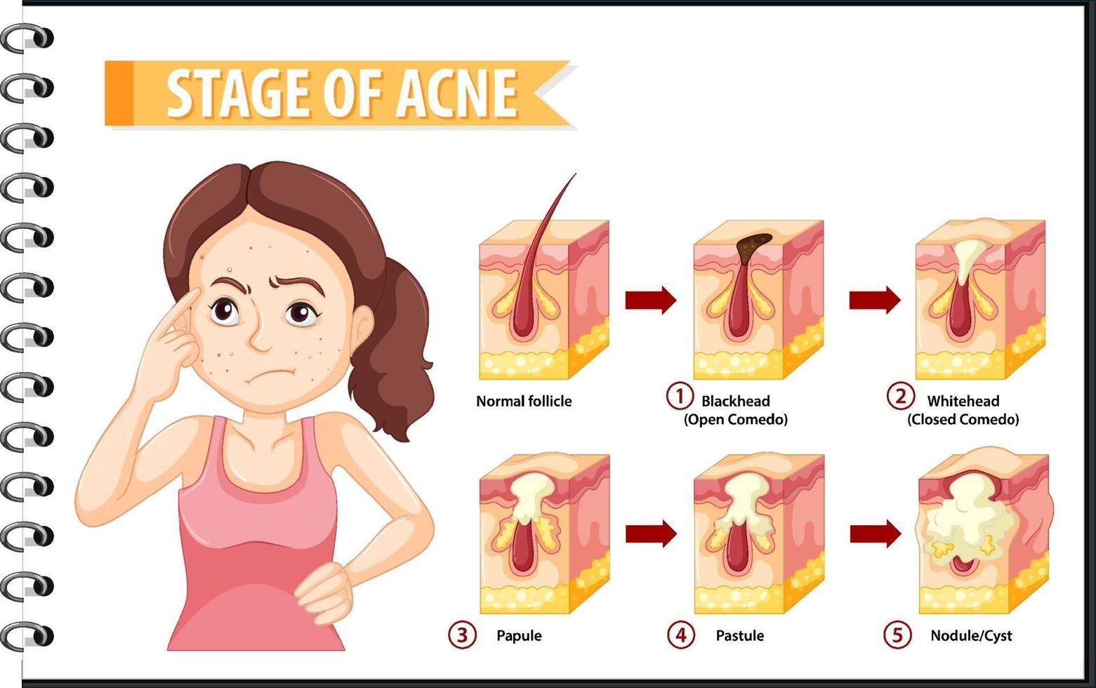 Stages of skin acne anatomy with a woman doing stressful pose vector