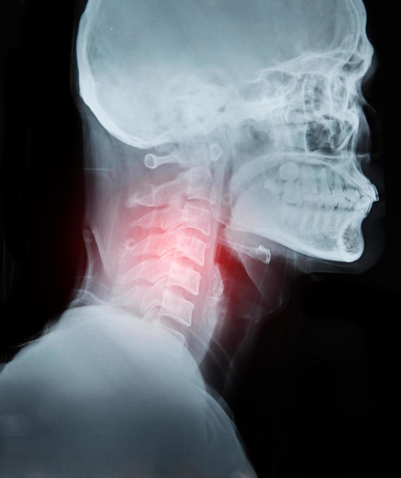 X-ray image film detail of neck and red zone pain photo