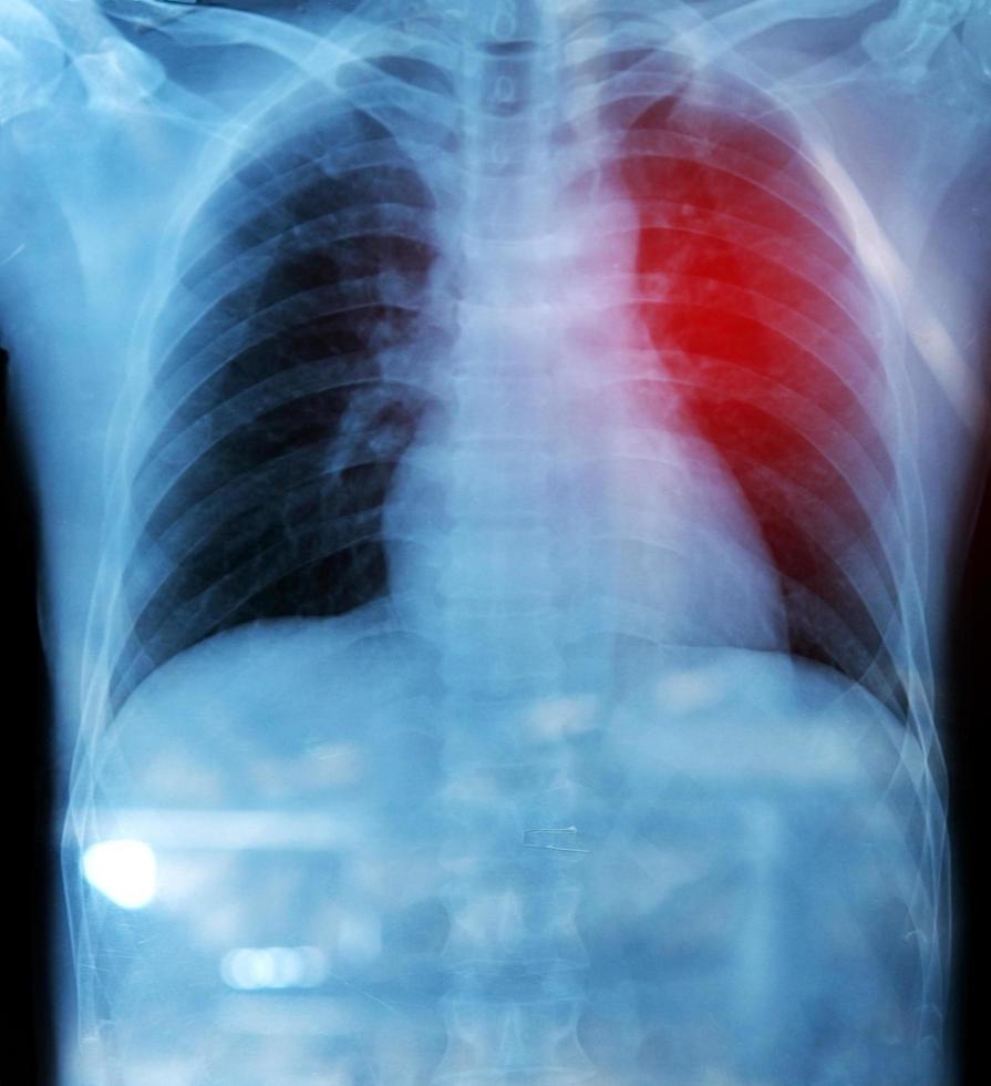 X-ray film of chest and stomach under dome of the diaphragm photo