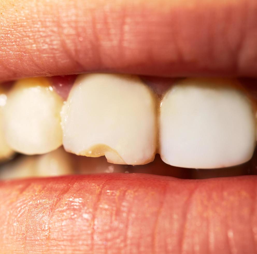 Close-up of a chipped tooth photo