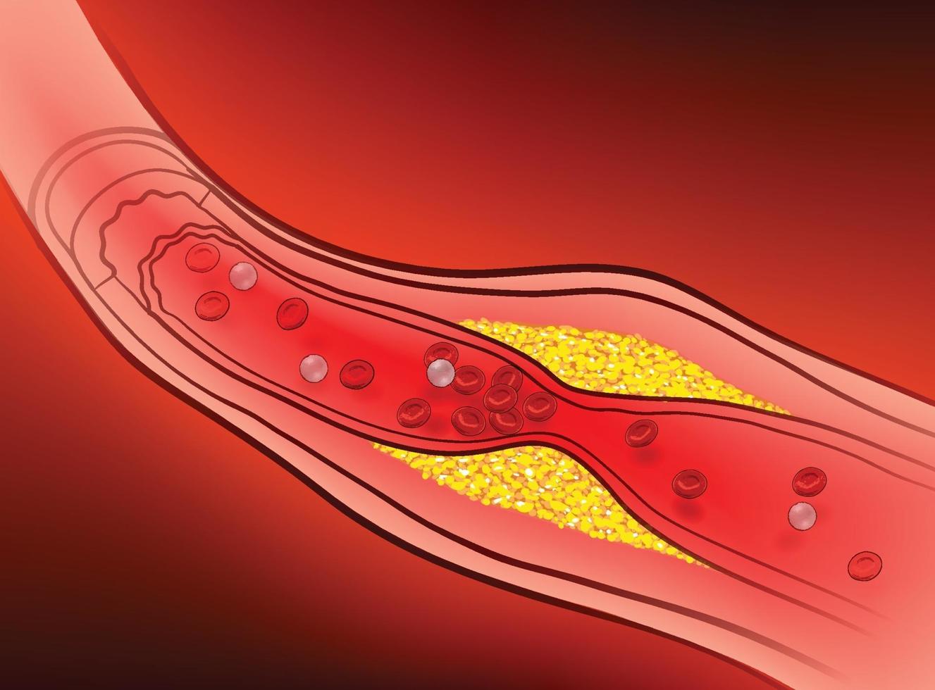 Arteries with clogged fat that causes blood clots. vector