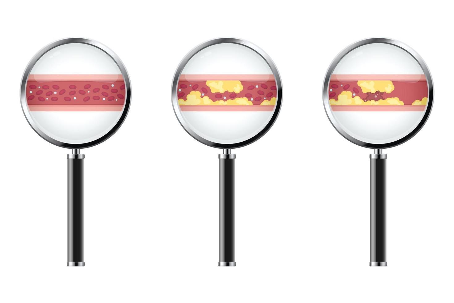 Blood vessels with atherosclerosis vector illustration