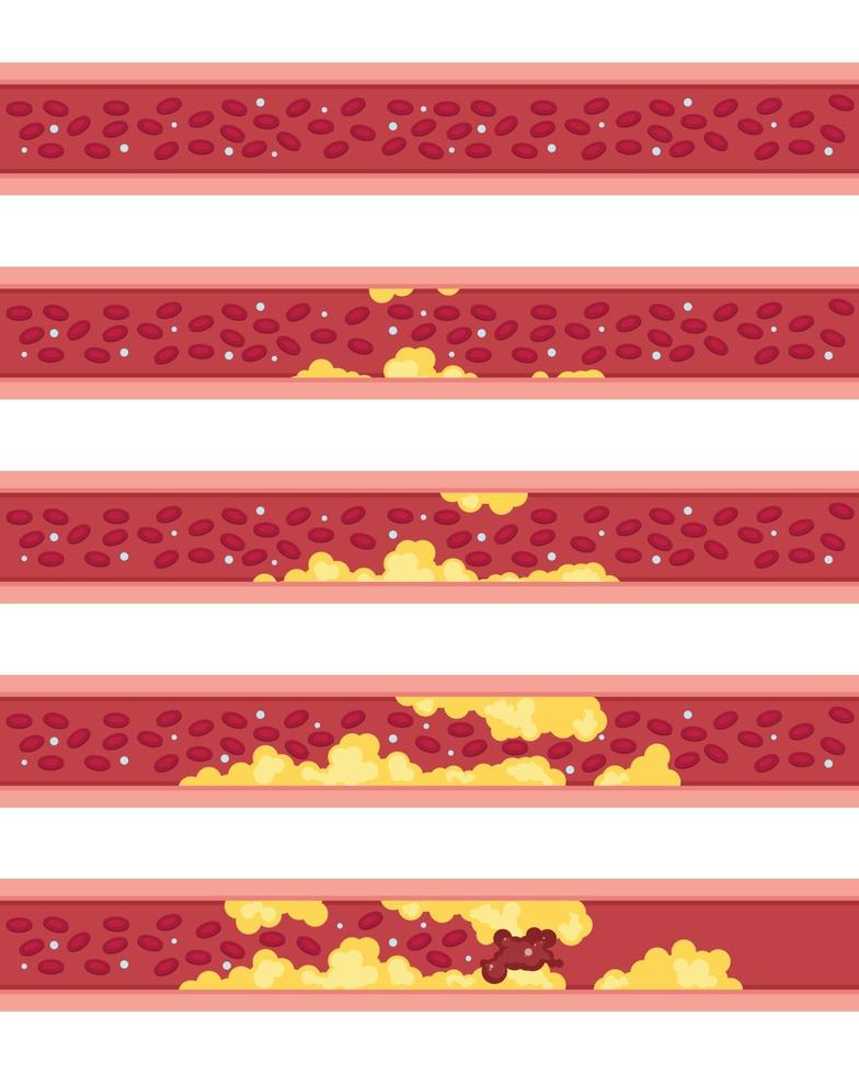 Phases of atherosclerosis vector illustration