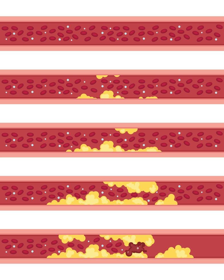 fases de la aterosclerosis ilustración vectorial vector