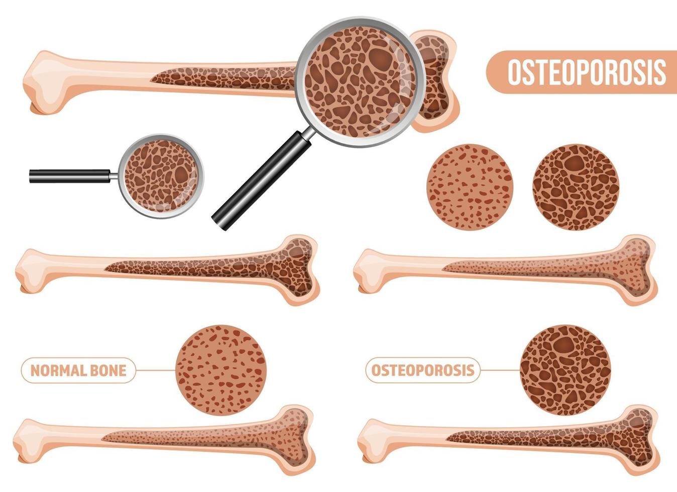 Osteoporosis vector design illustration set isolated on white background