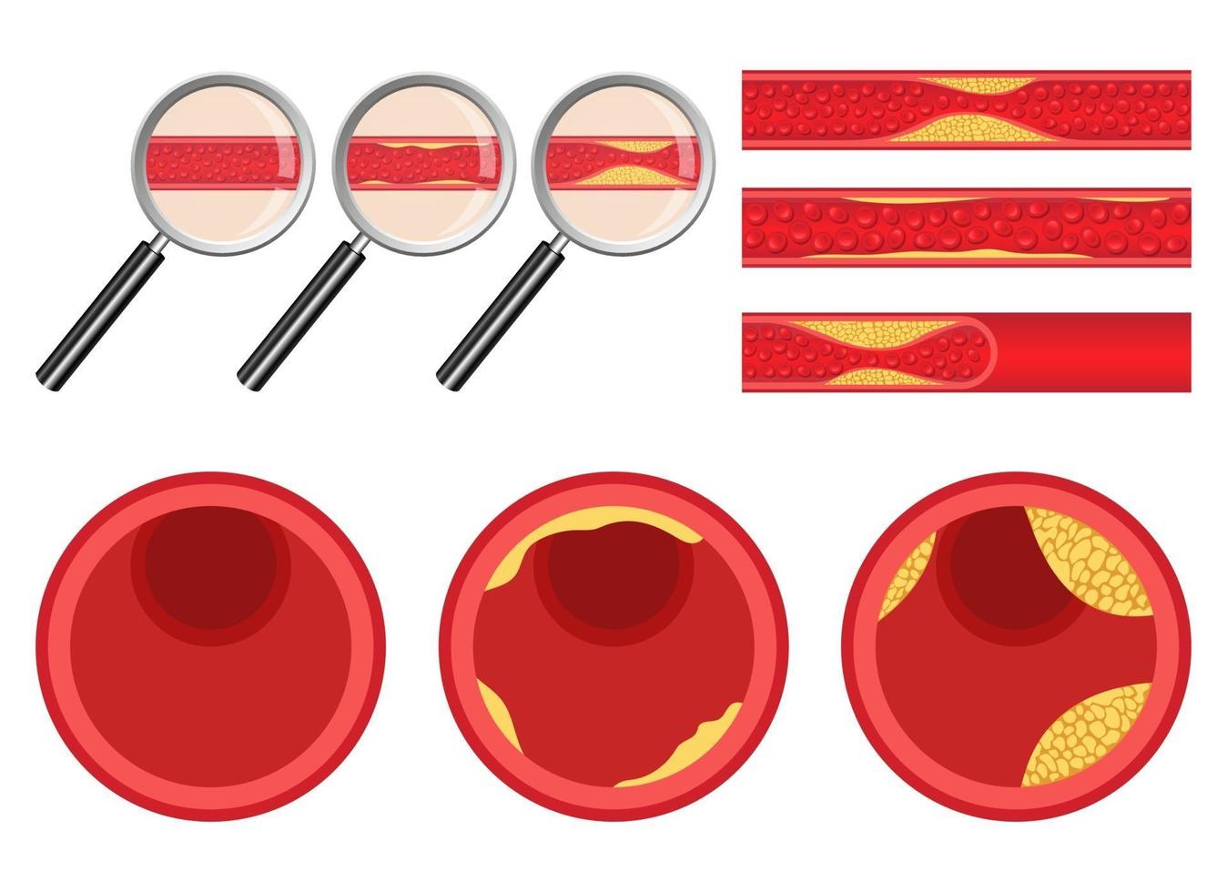 Conjunto de ilustración de diseño de vector de arteriosclerosis aislado sobre fondo blanco