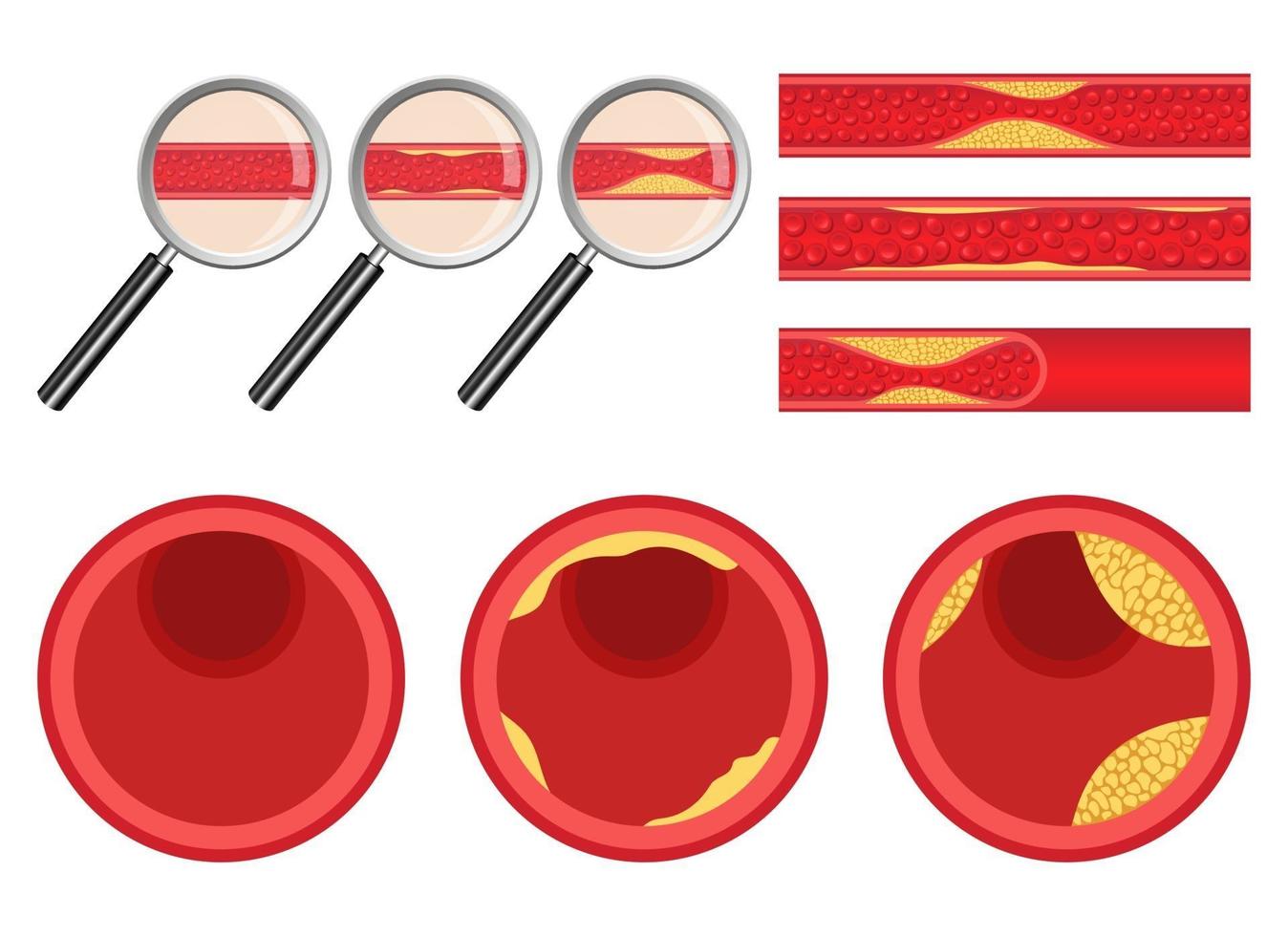 Arteriosclerosis vector design illustration set isolated on white background