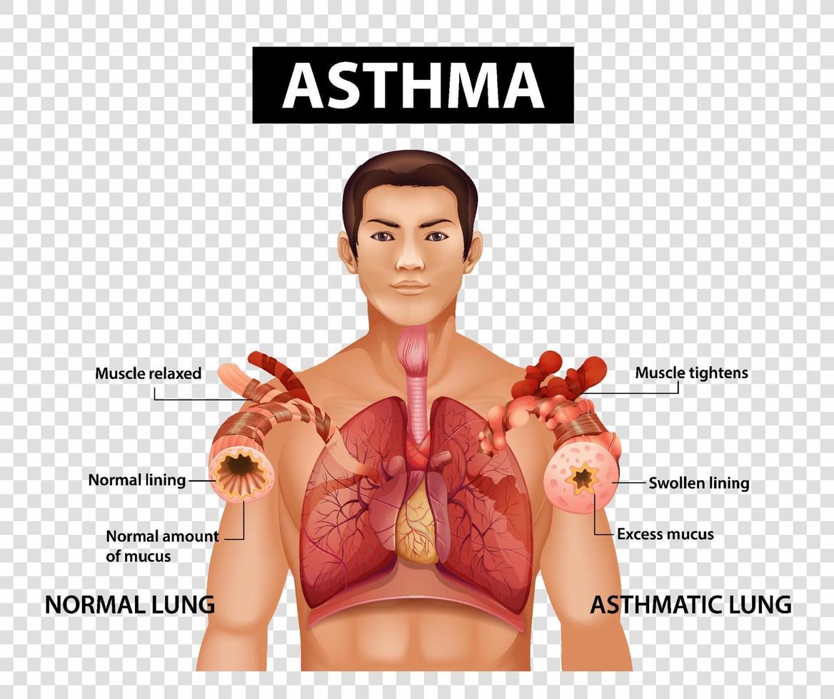 diagrama que muestra el asma sobre fondo transparente vector