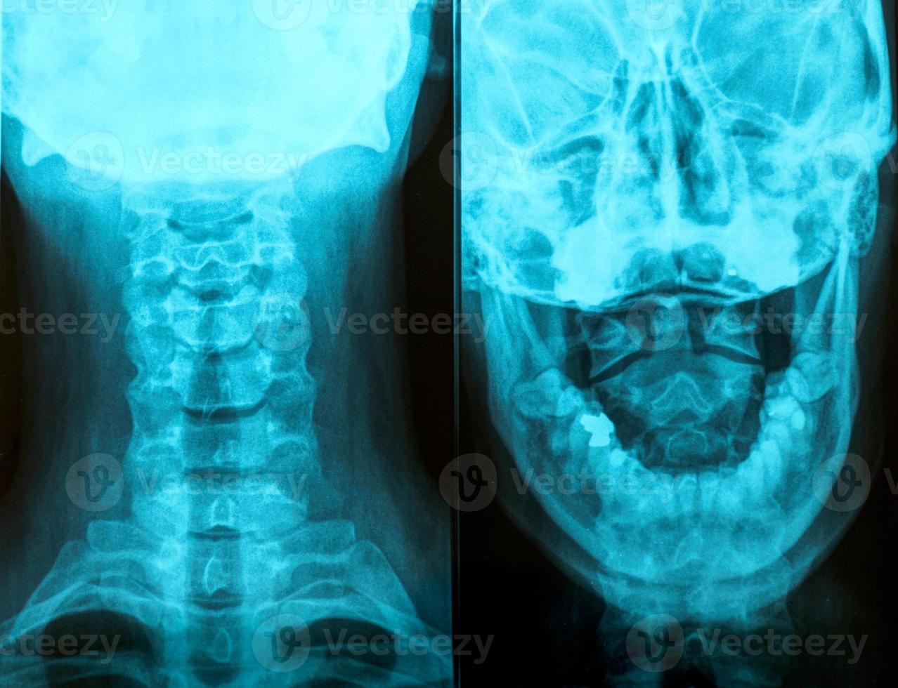 Radiography of the head photo