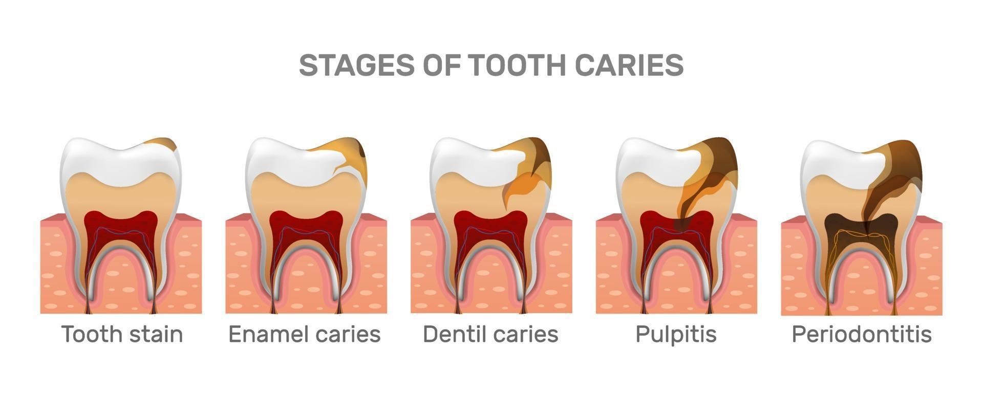 Tooth caries structure and full placement steps in realistic style. Stain, enamel caries, dentil, pulpitis, periodontitis. Gingiva. Vector illustration 3d.