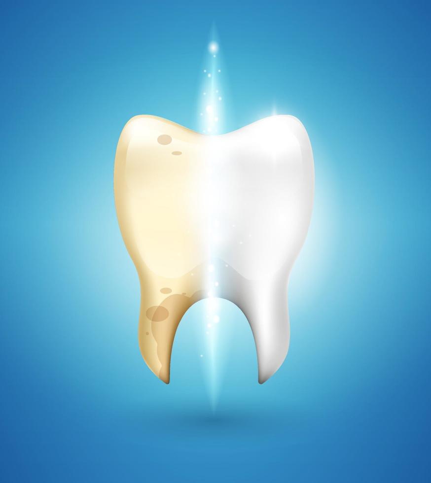 Tooth whitening in 3d style. Dental brushing of calculus and caries removal. Difference after brushing. Vector realistic illustration.