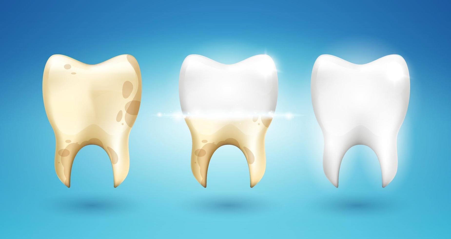 Tooth whitening in 3d style. Difference after brushing. Vector realism illustration.
