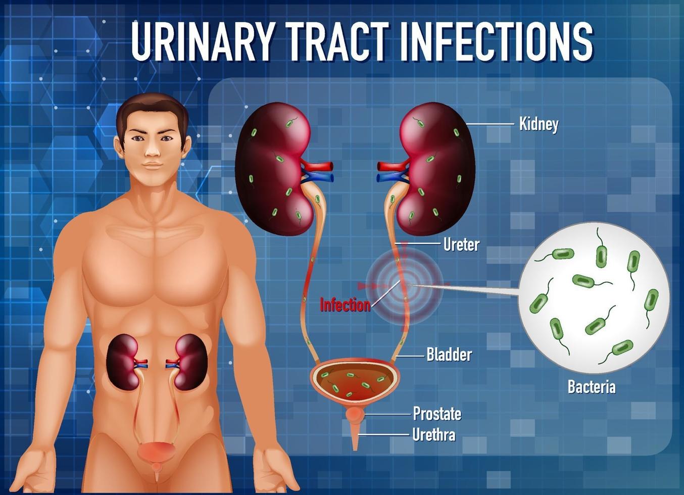 Information poster of urinary tract infections vector