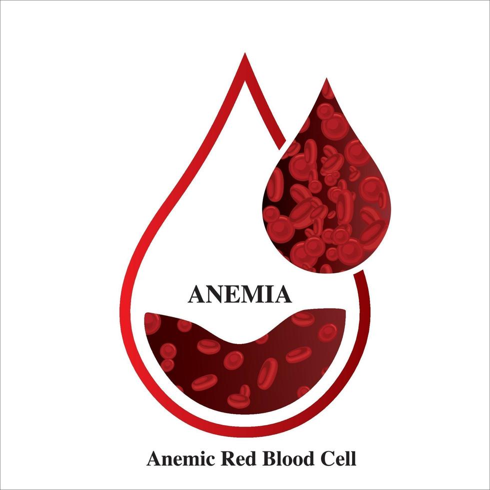 anemia cantidad de sangre roja deficiencia de hierro anemia diferencia de anemia cantidad de glóbulos rojos y síntomas normales ilustración vectorial médica. vector