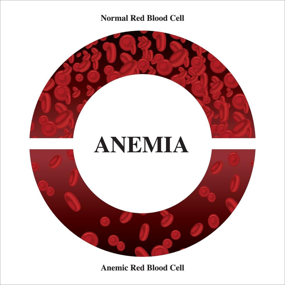 anemia cantidad de sangre roja deficiencia de hierro anemia diferencia de anemia cantidad de glóbulos rojos y síntomas normales ilustración vectorial médica. vector