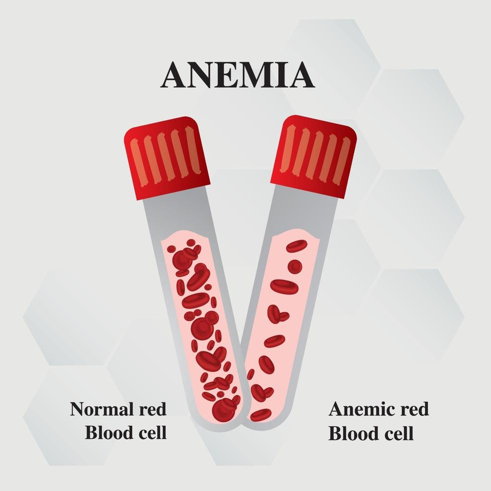 anemia cantidad de sangre roja deficiencia de hierro anemia diferencia de anemia cantidad de glóbulos rojos y síntomas normales ilustración vectorial médica. vector