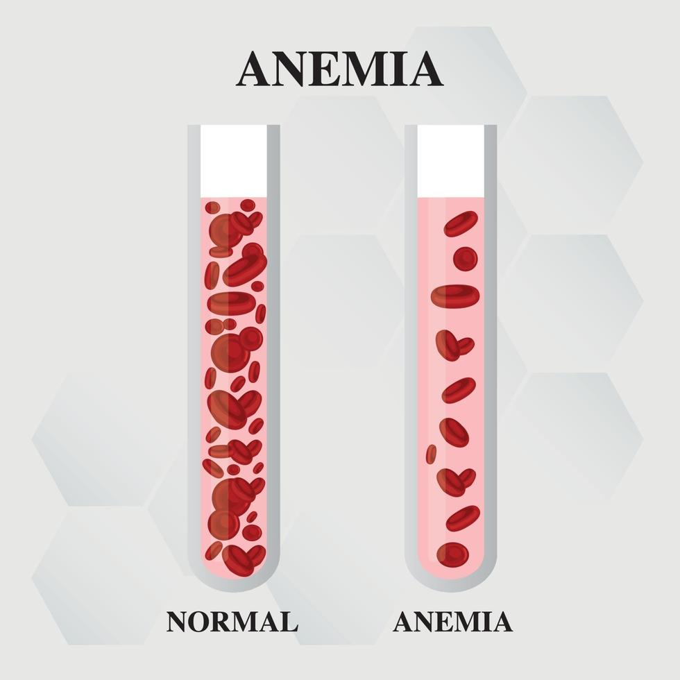 anemia cantidad de sangre roja deficiencia de hierro anemia diferencia de anemia cantidad de glóbulos rojos y síntomas normales ilustración vectorial médica. vector