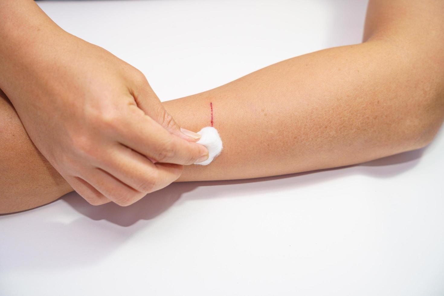 Person using a cotton ball to treat a wound photo