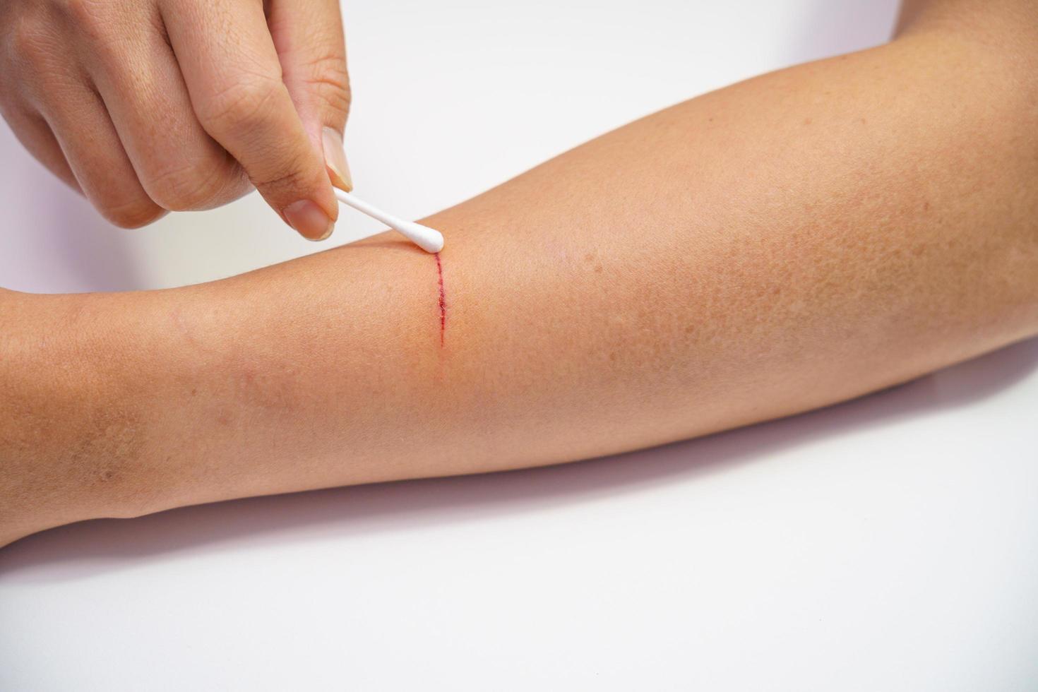 Person using a q tip to treat an arm wound photo