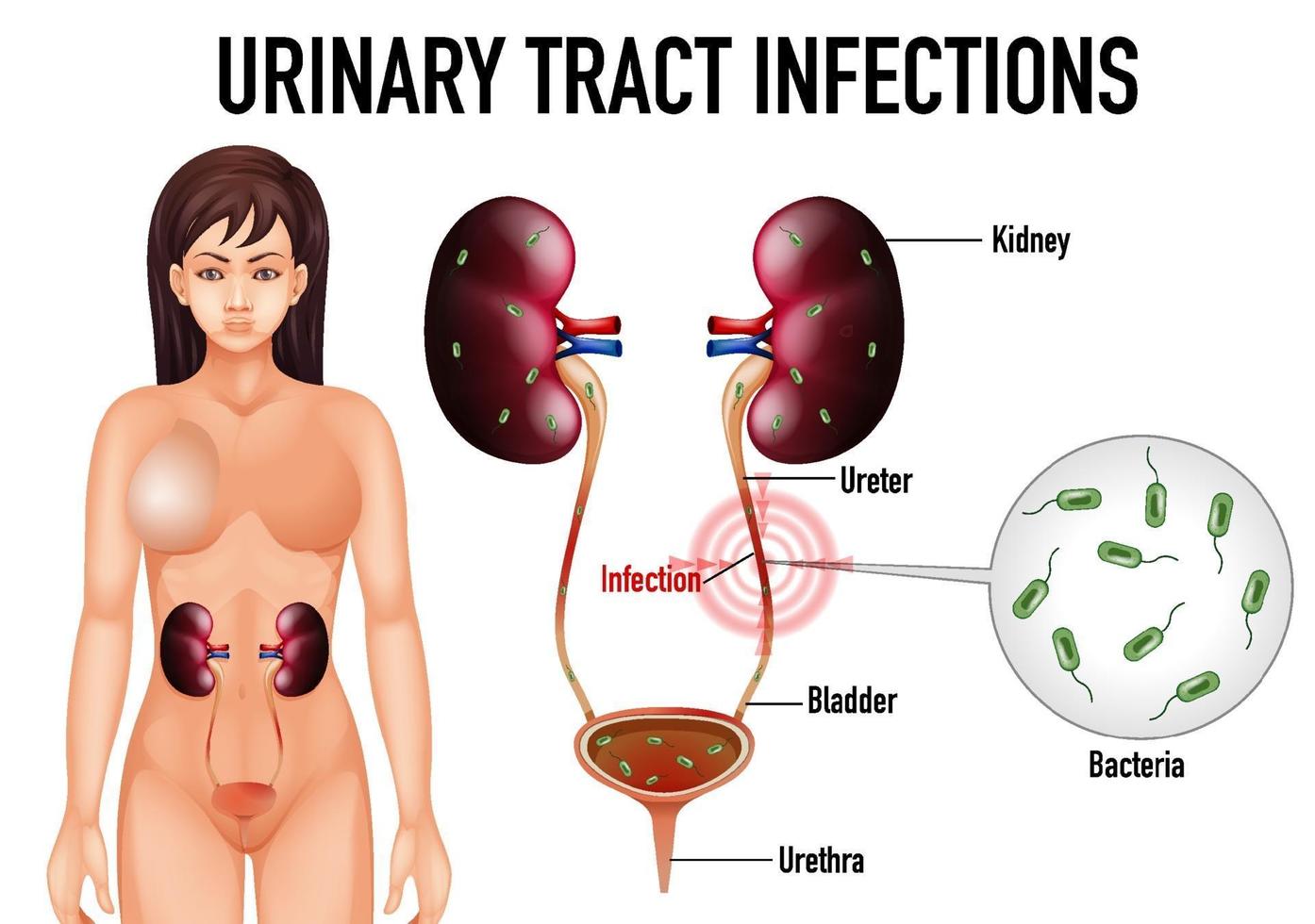 cartel informativo sobre infecciones del tracto urinario vector