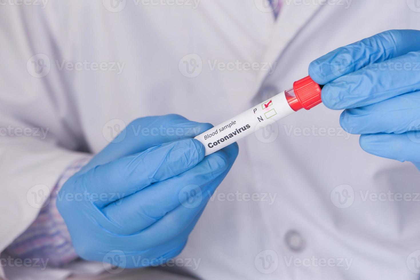 La mano del técnico de laboratorio que sostiene el tubo de ensayo de sangre foto