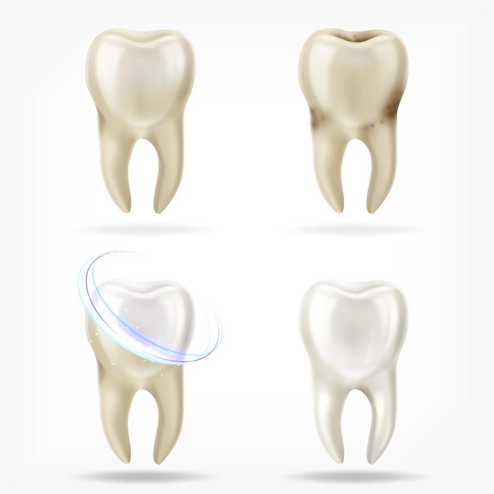 Conjunto de vector de diente limpio y sucio realista 3d, proceso de limpieza de diente. cuidado bucal, restauración de dientes