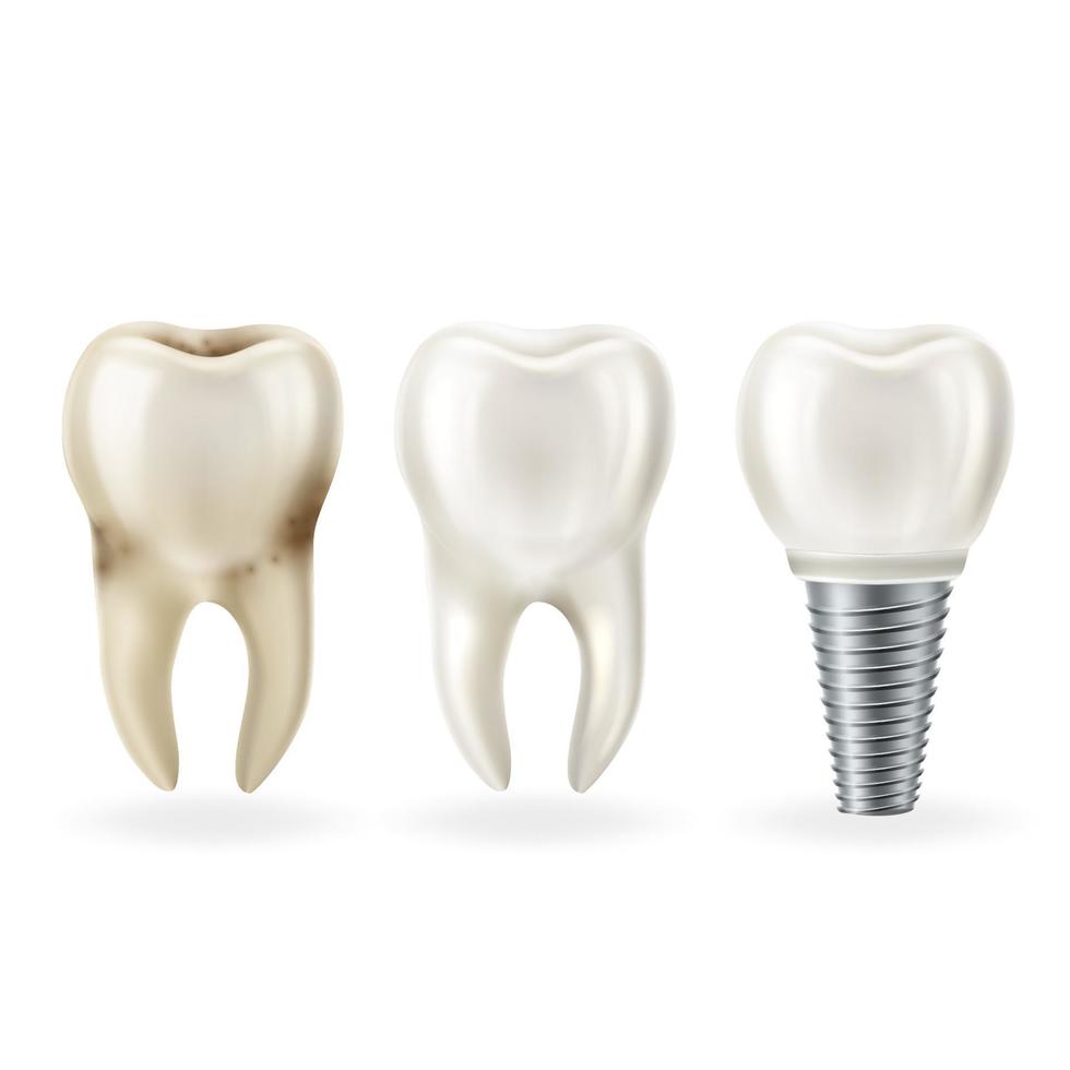 Realistic healthy tooth, tooth with caries and dental implant with screw. Vector illustration