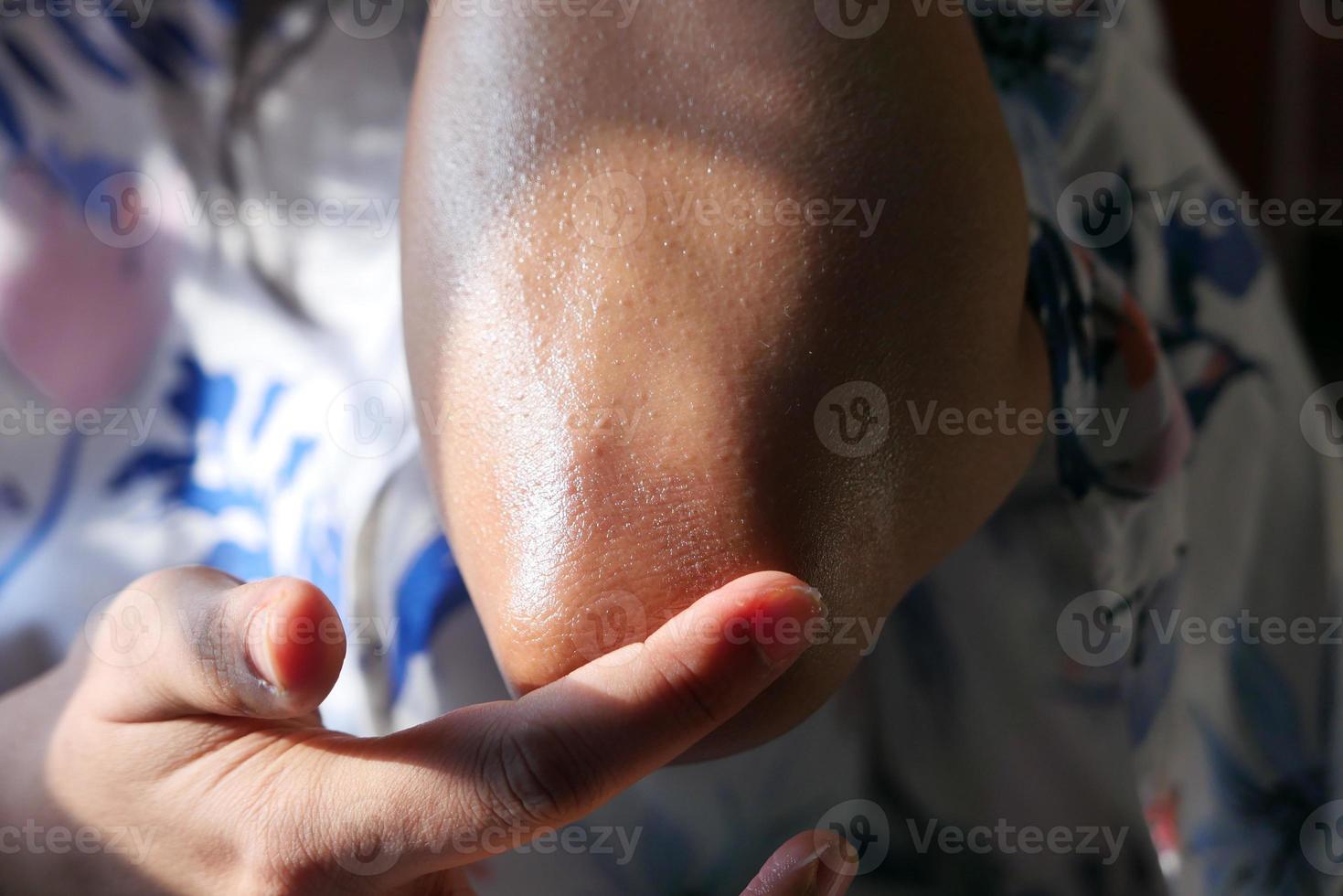 Person rubbing elbow photo