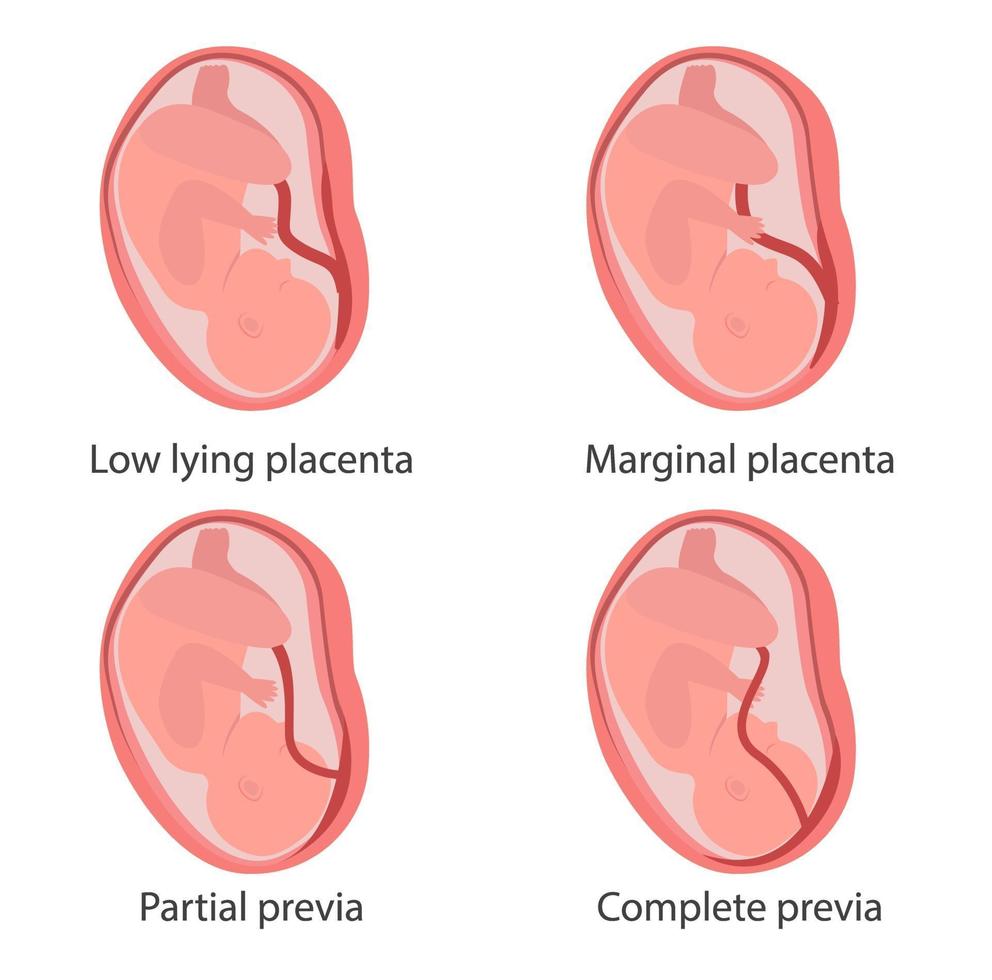 Four types of placenta previa concept illustration vector