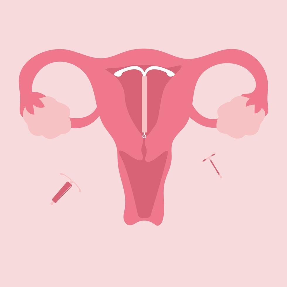 Flat illustration of birth control IUD vector