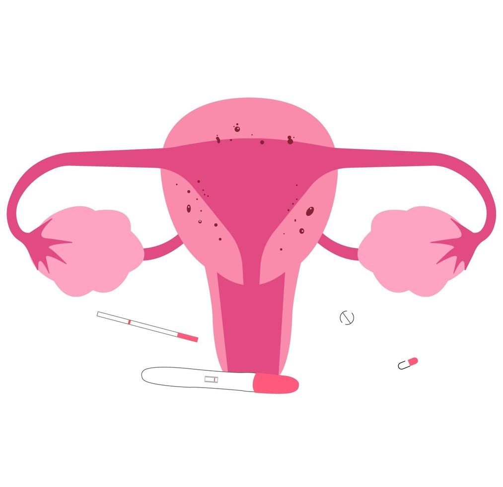 Adenomyosis, one of medical condition of female reproduction organ. Infertility causes. vector