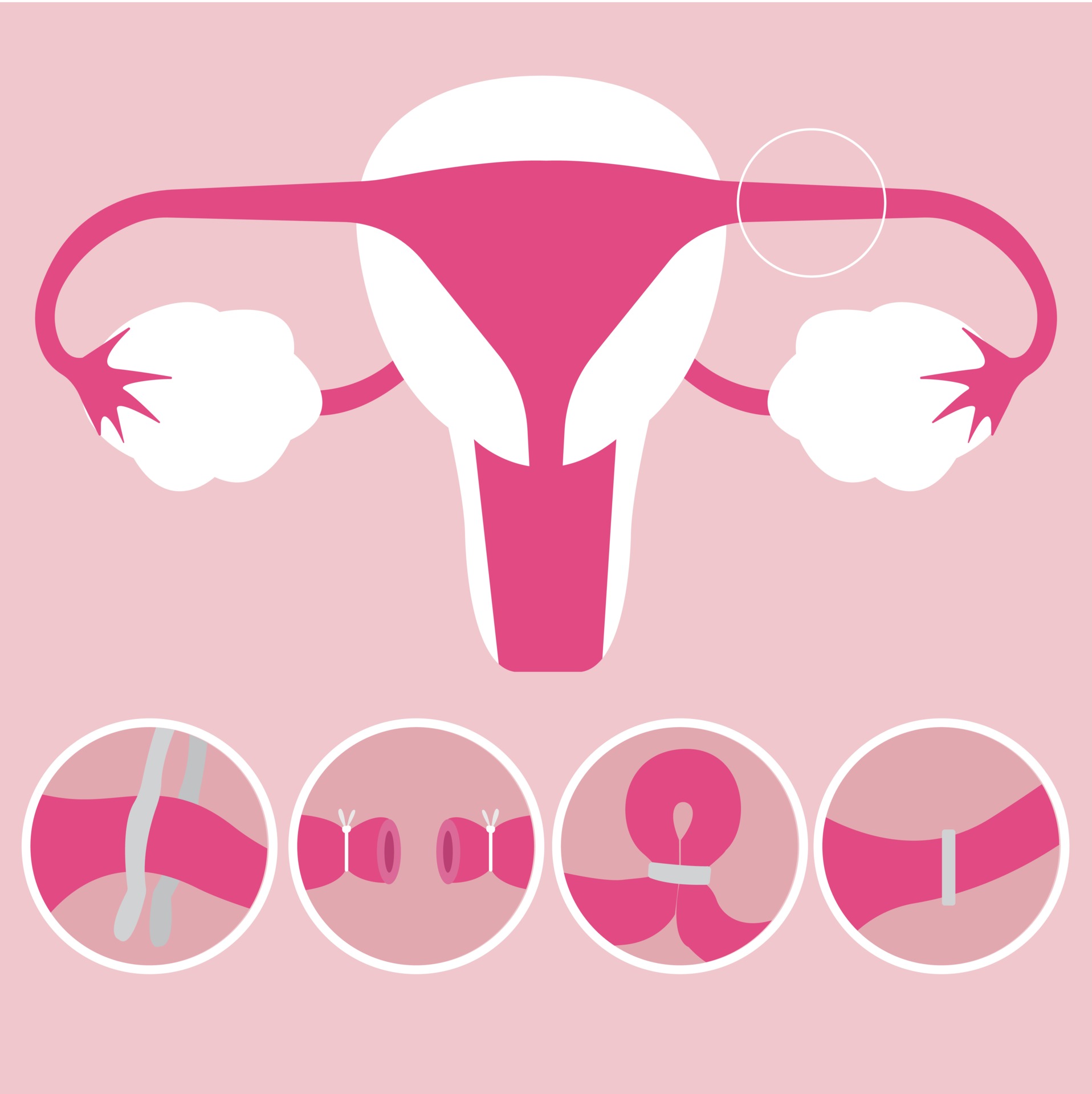 Pregnancy After Tubal Ligation: Doctors' Explanations - 8u5z6s5