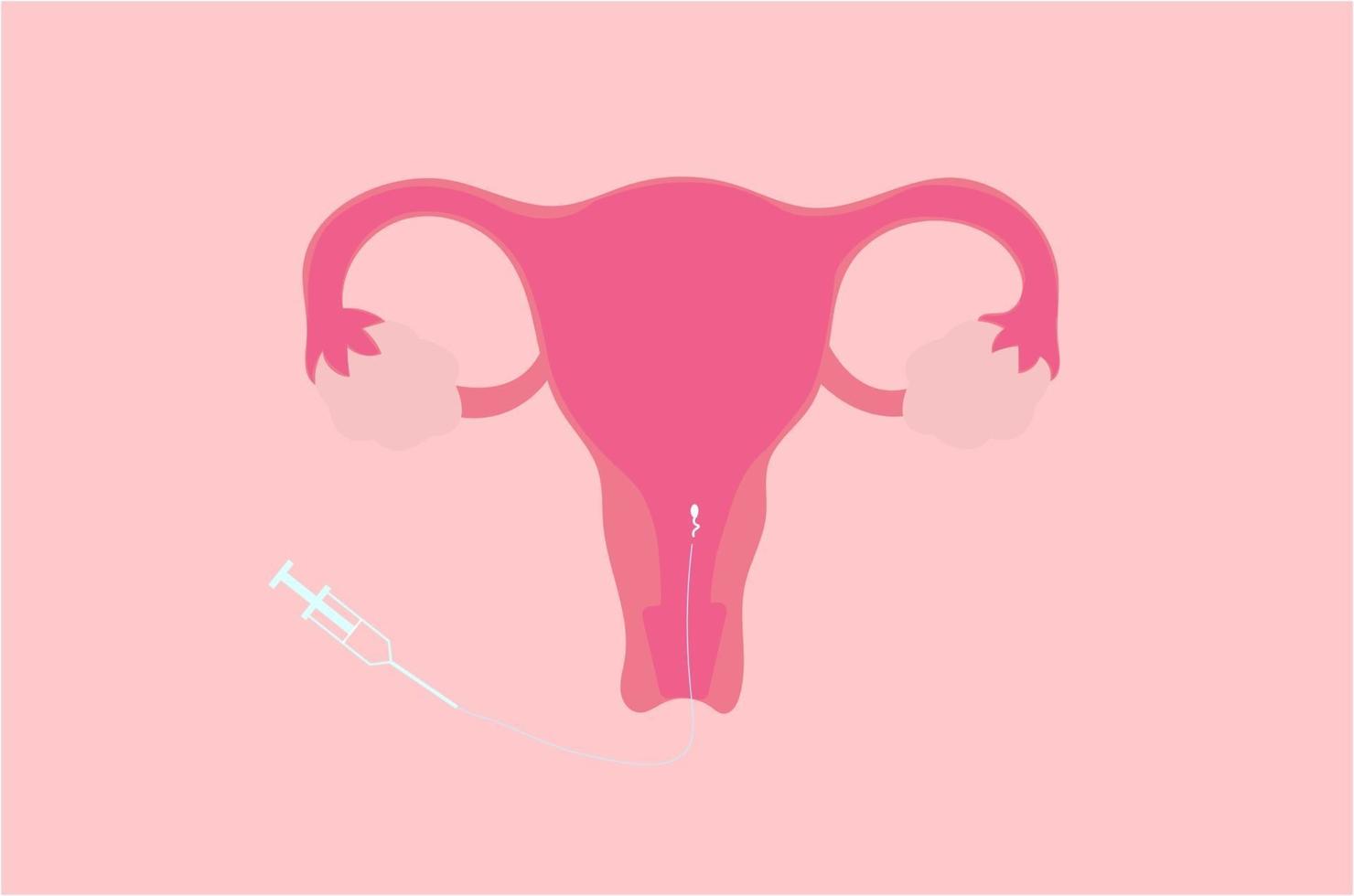 Vector illustration of intrauterine insemination or IUI