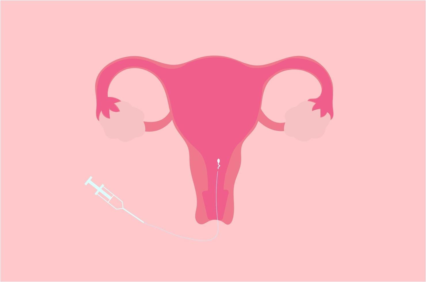 ilustración vectorial de inseminación intrauterina o iui vector