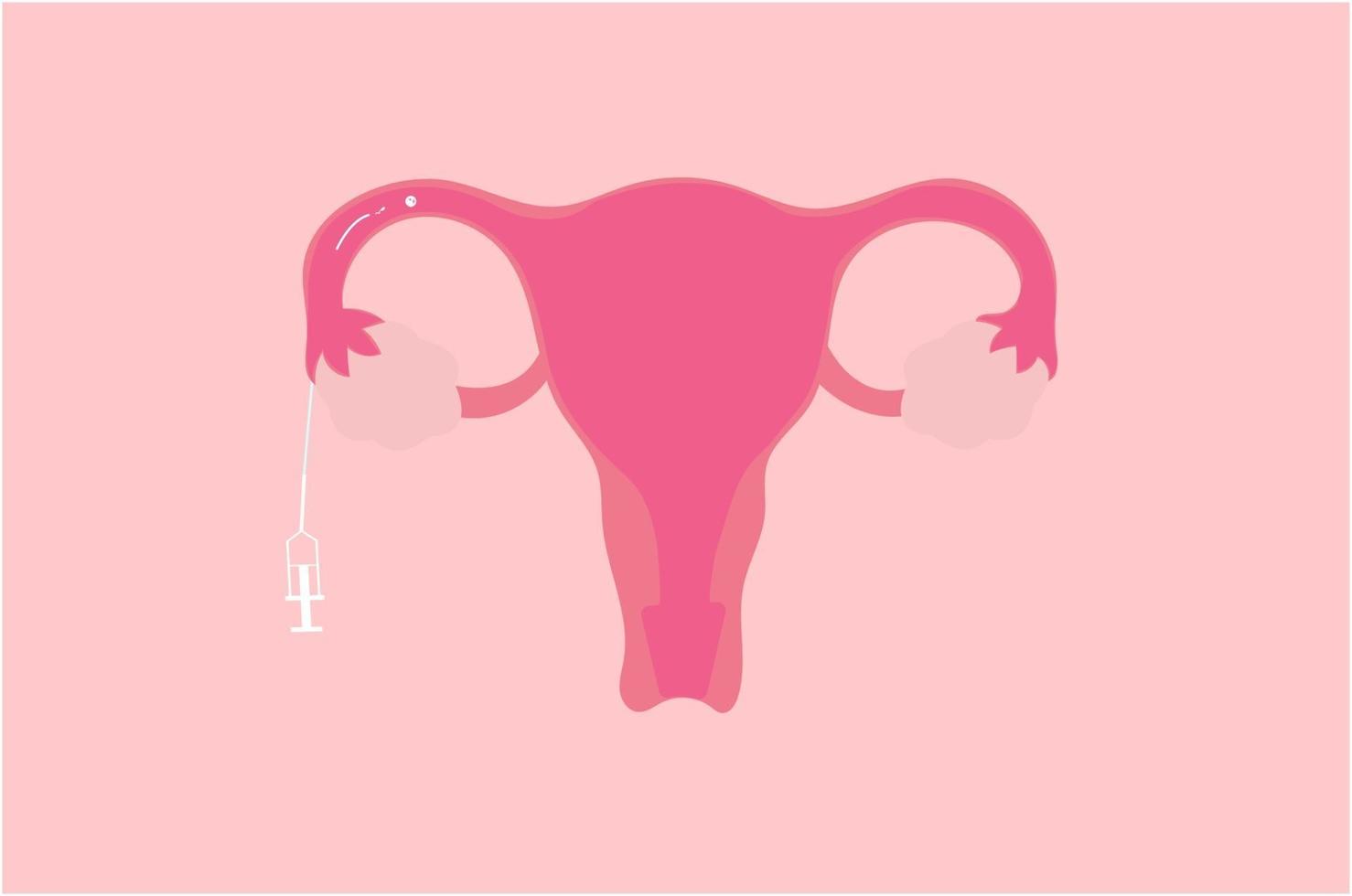 Vector illustration of intratubal insemination or ITI