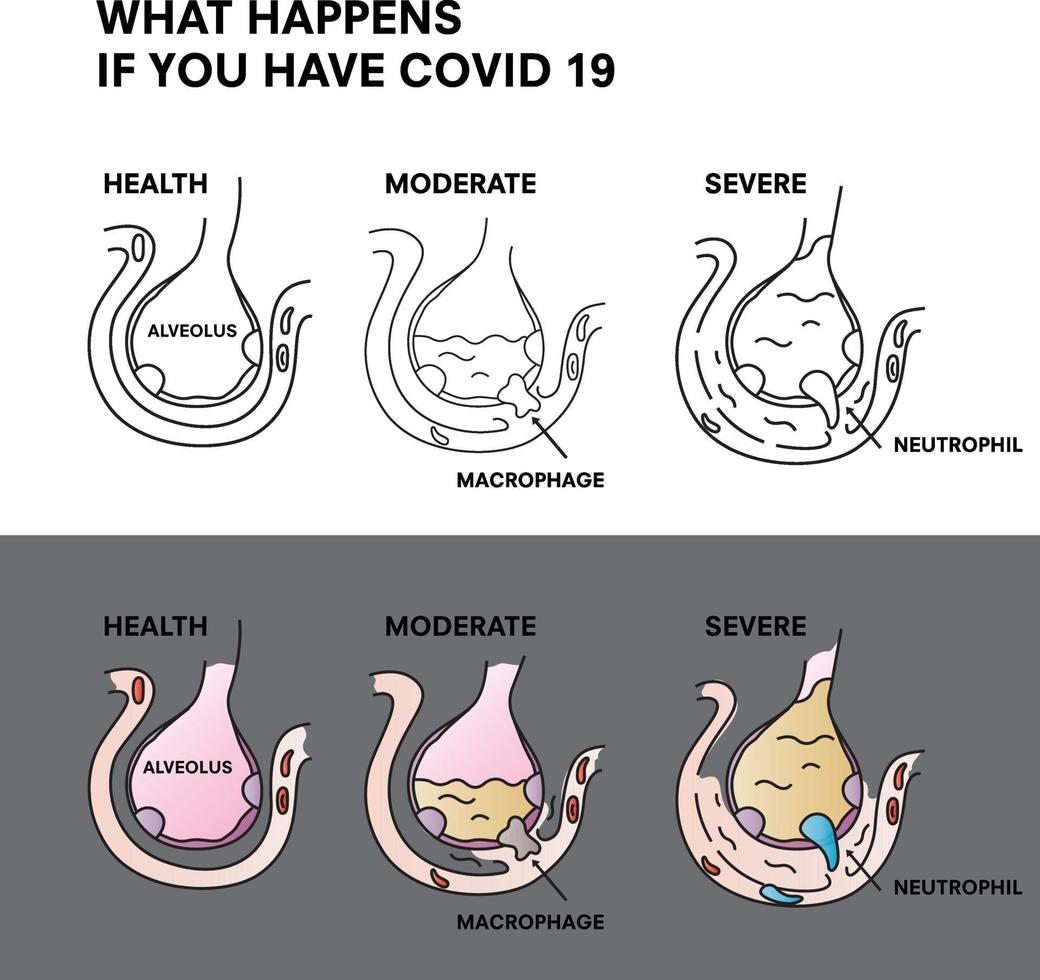 Coronavirus 2019-nCoV Infographic, What happens if you have Covid 19. Virus or bacterial infects lungs. Virus invades alveoli. Structure of alveolus of human lungs with Corona. vector