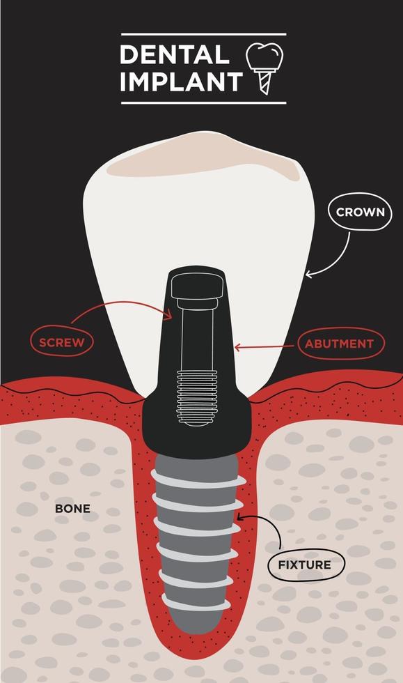 estructura de implante dental. infografía educativa médica. Ilustración de vector de información de implante dental