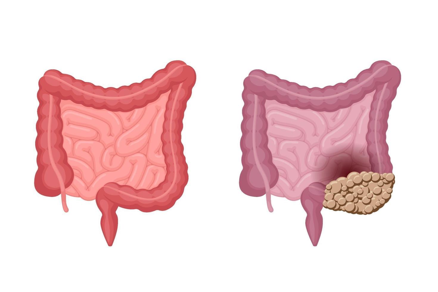 Anatomía de los intestinos humanos fuerte, saludable e insalubre con la comparación del cáncer de colon. tumor de oncología de órganos internos digestivo y excretor de la cavidad abdominal. problema de digestión vectorial eps ilustración vector