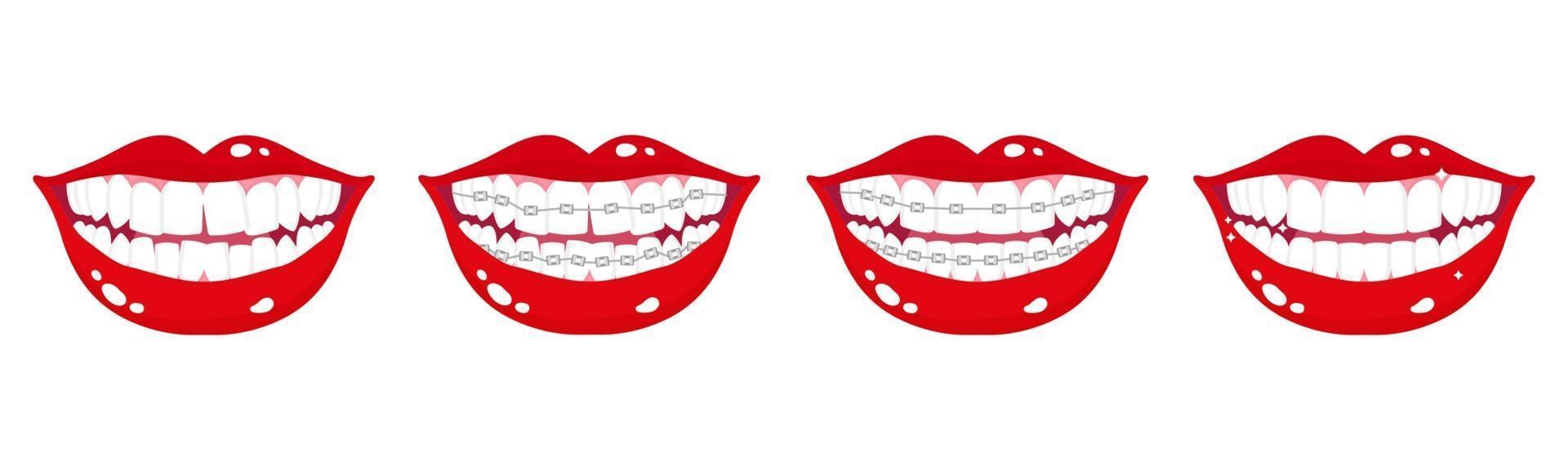 Conjunto de dibujos animados vectoriales de bocas sonrientes con etapas de alineación de los dientes con aparatos de ortodoncia metálicos sobre un fondo blanco. vector