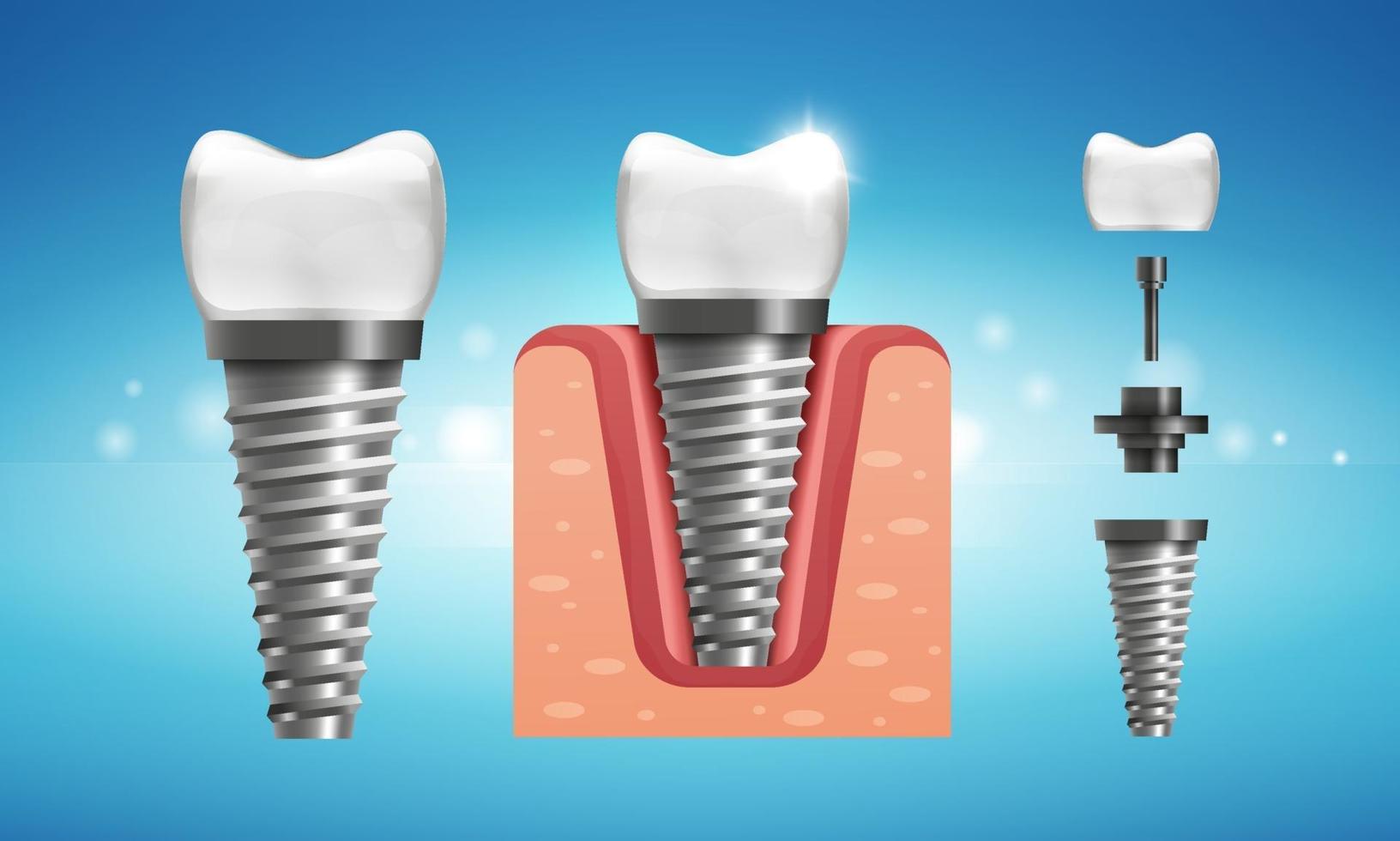 Dental implant structure in realistic style vector