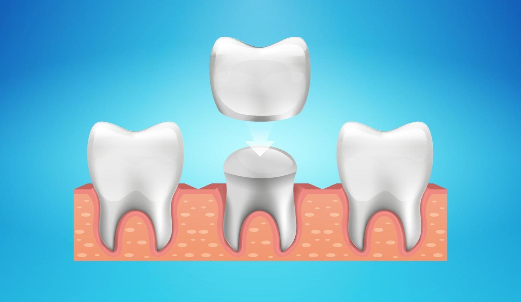 restauración de corona dental en estilo realista vector