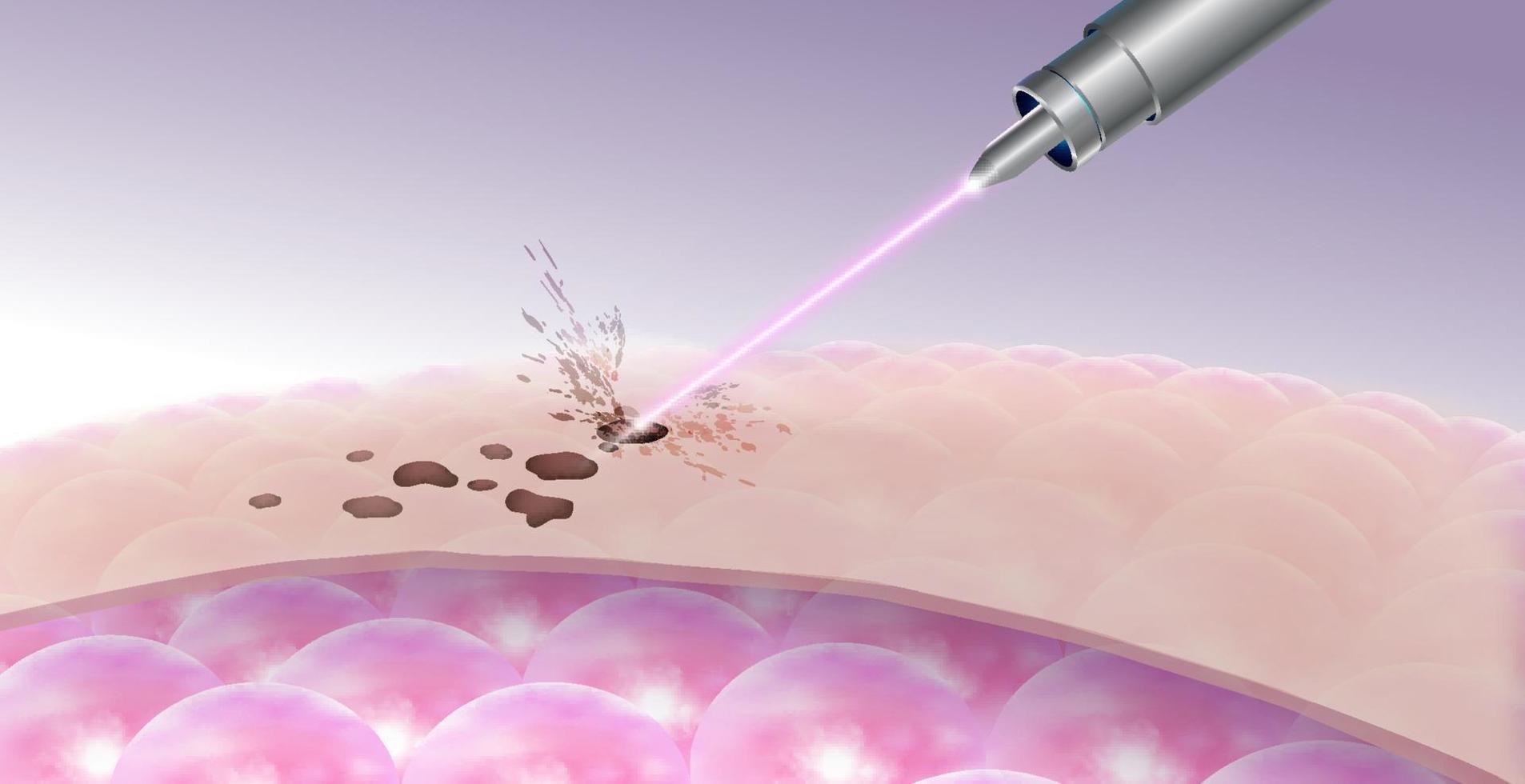 pecas manchas oscuras eliminación con láser vector