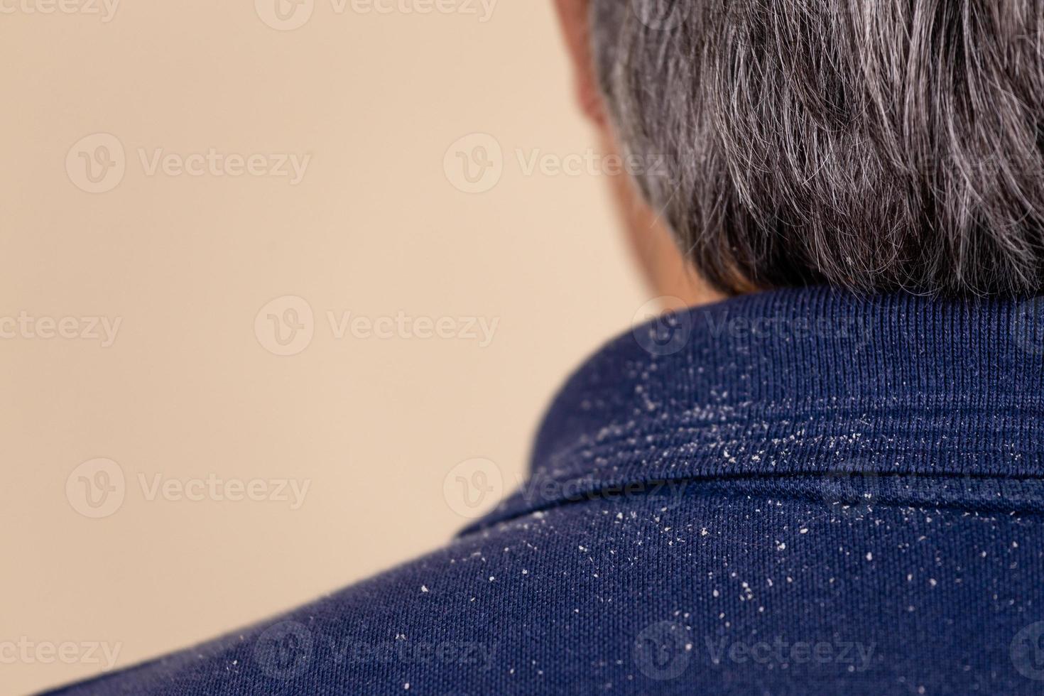 Close-up view of a man who has a lot of dandruff photo