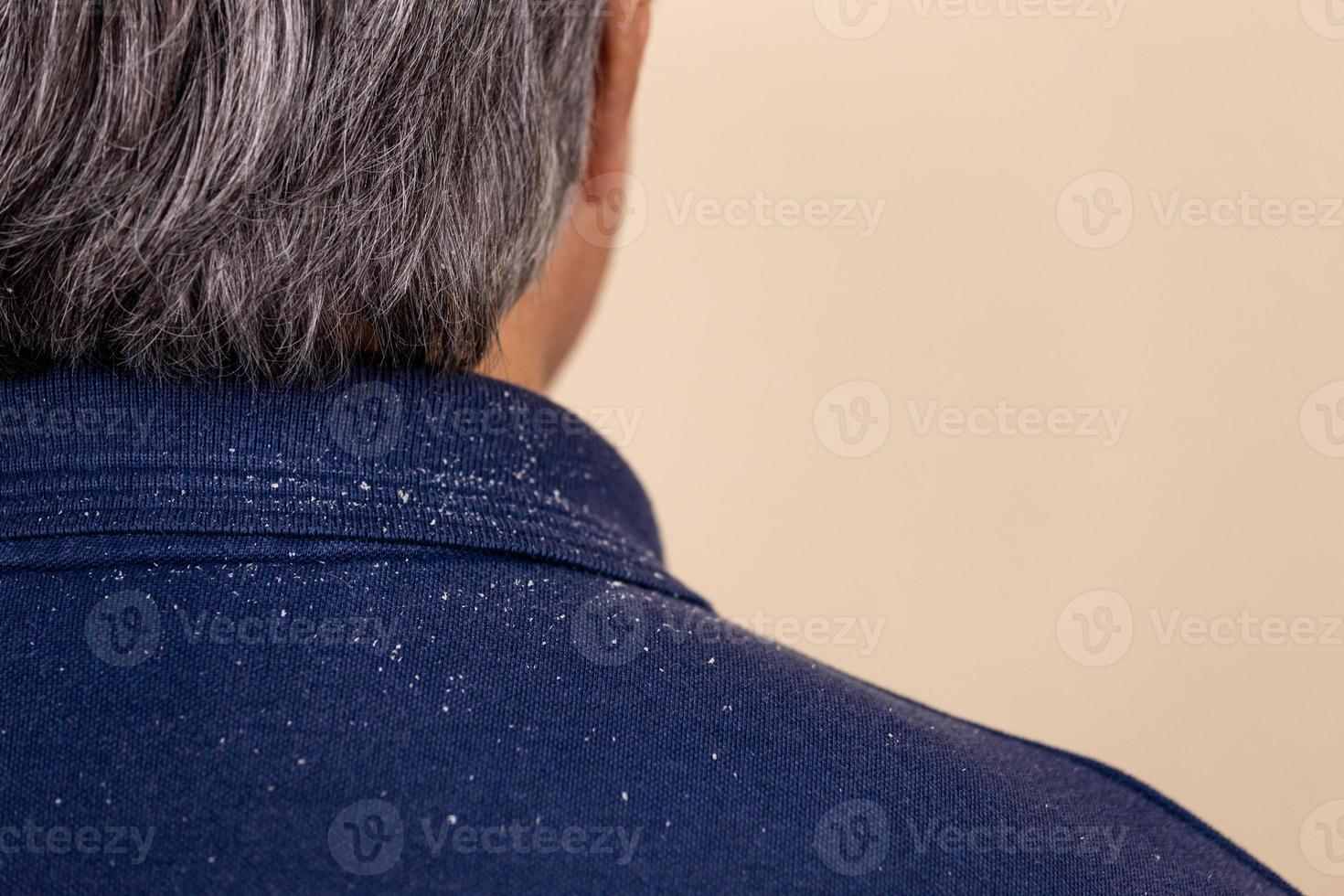 Close-up view of a man who has a lot of dandruff photo