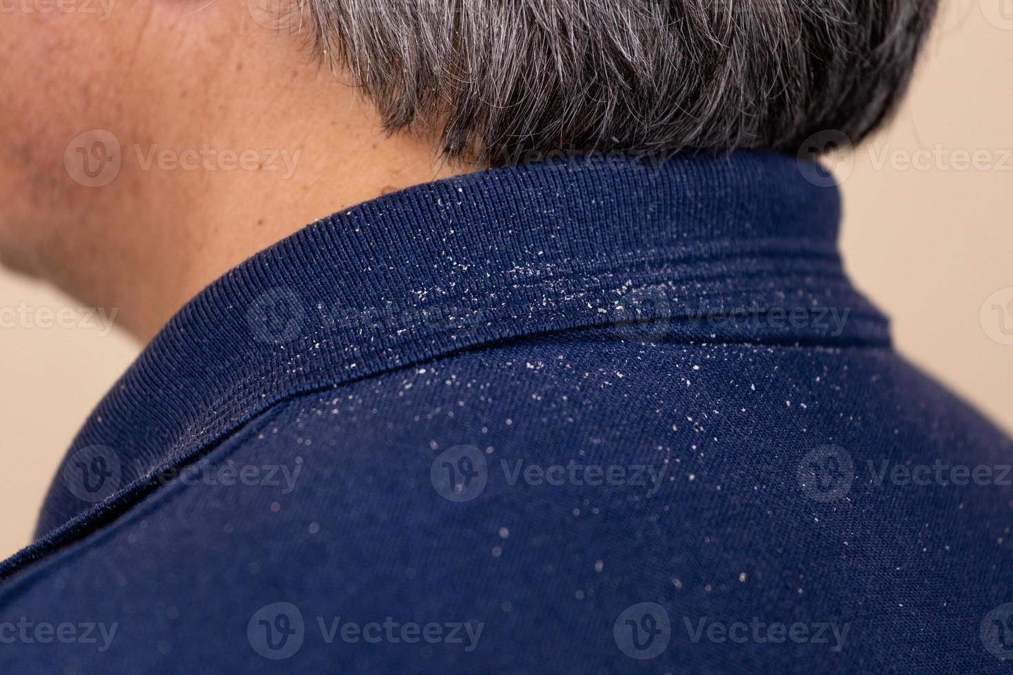 Close-up view of a man who has a lot of dandruff photo