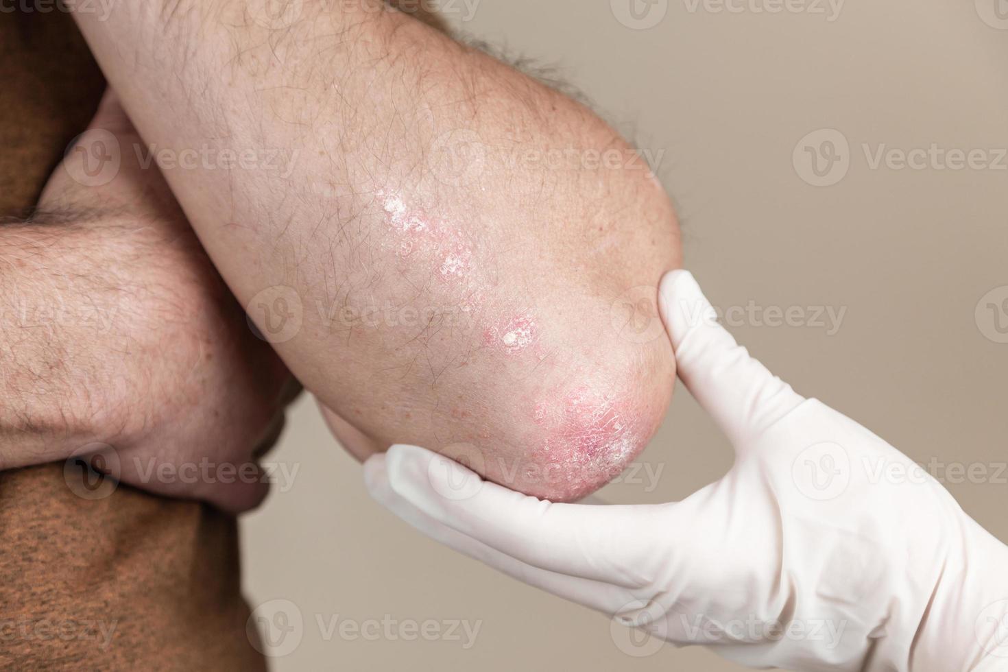 el médico examina la psoriasis foto